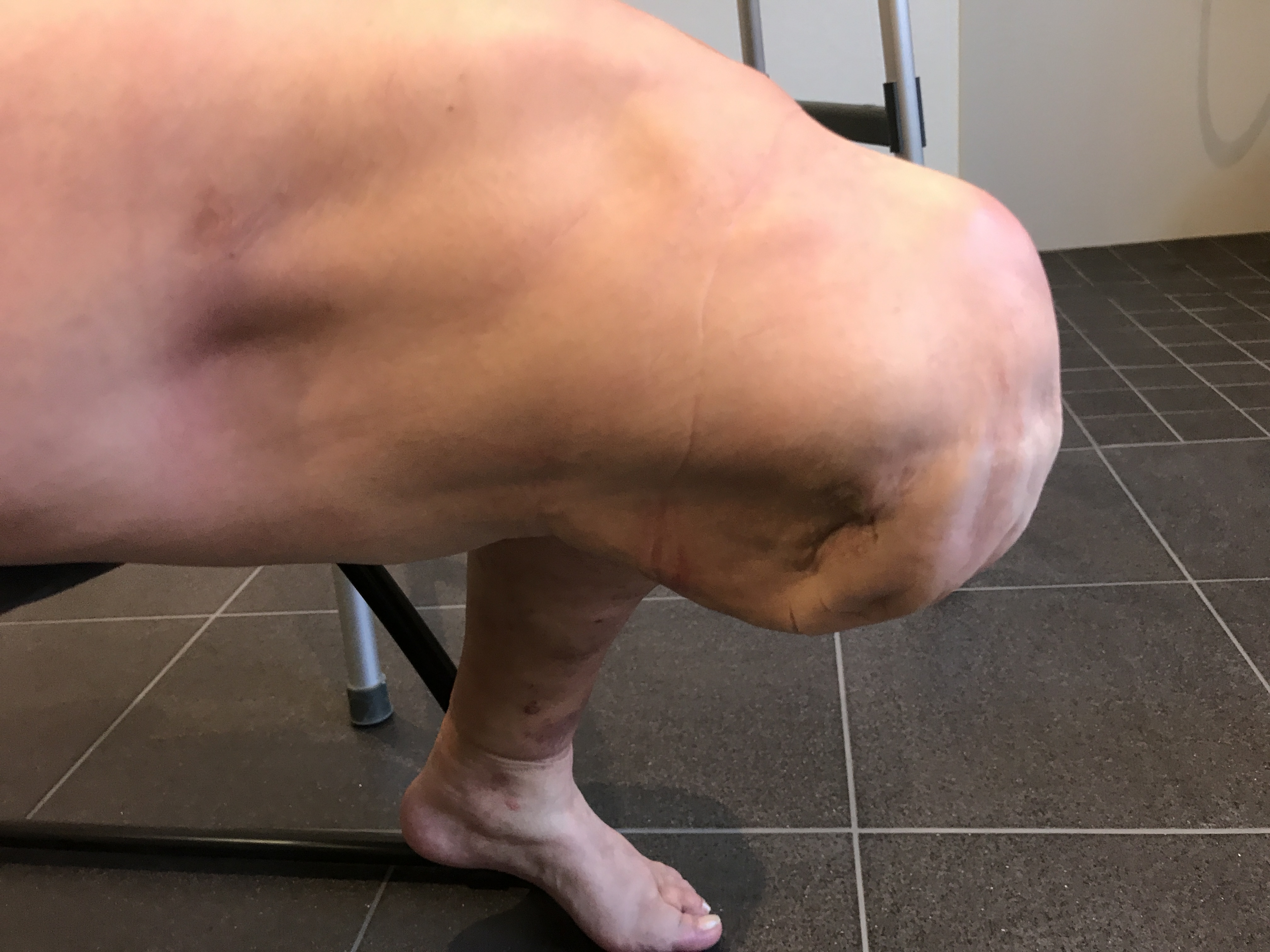 Beinstumpf nach Amputation